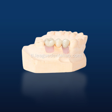3D na naka -print na modelo ng pagpapanumbalik ng implant